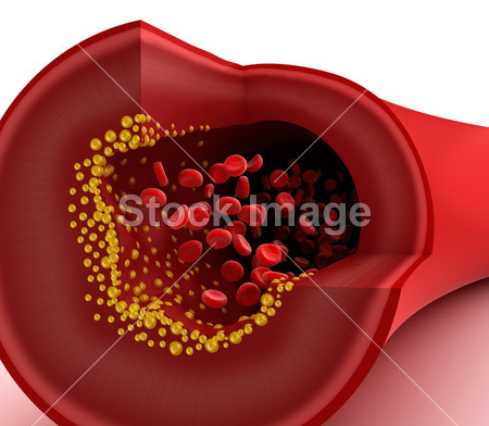 在血管中的胆固醇斑块的特写视图图片素材(图