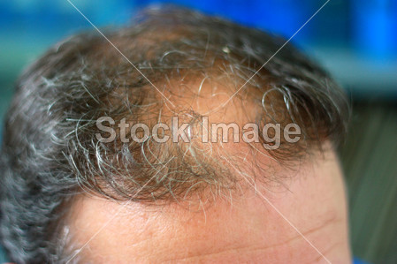 <em>头发</em>损失<em>症状</em>男性头部正面图片素材(图片编号