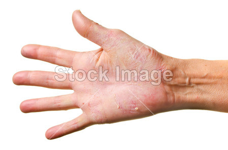 一只手上的湿疹图片素材(图片编号:50809206
