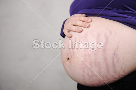 怀孕女人的天然肚子-在皮肤上的裂缝图片素材