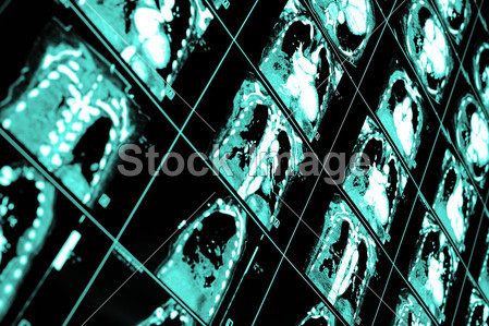 Computed tomography (CT) of the chest.图片素
