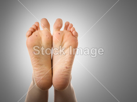 Feet with plantar warts. High definition image.图